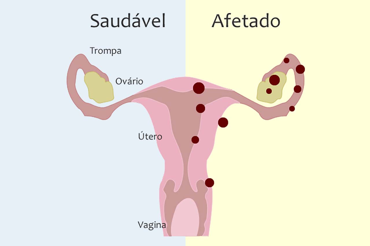 Dor E Sangramento S O Os Principais Da Sintomas Da Endometriose Marco