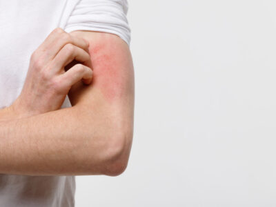 Alergia na pele: causas, sintomas, tipos e tratamentos