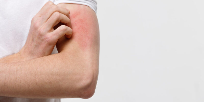 Alergia na pele: causas, sintomas, tipos e tratamentos