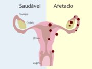 Sintomas da endometriose