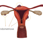 Quais são as causas da endometriose?