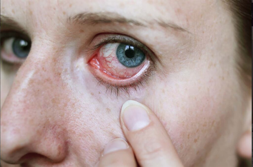 Herpes Zoster no olho: causas, sintomas e tratamentos