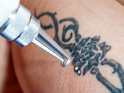 remoção de tatuagem